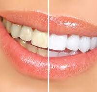 Oralzo Teeth Whitening
